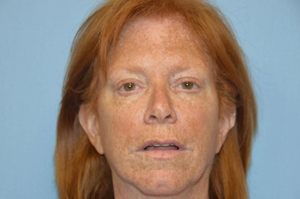 Facelift Before & After Gallery - Patient 6389909 - Image 1