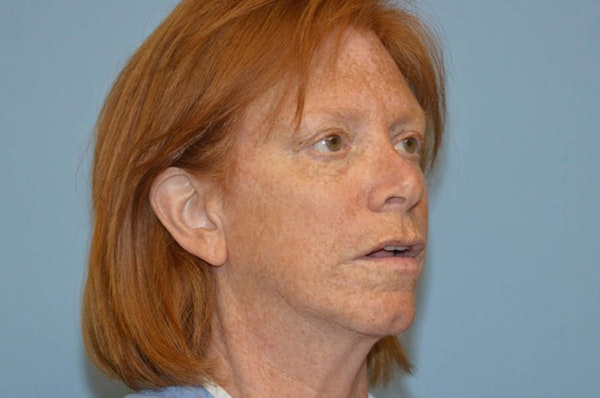 Facelift Before & After Gallery - Patient 6389909 - Image 3