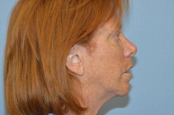 Facelift Before & After Gallery - Patient 6389909 - Image 5