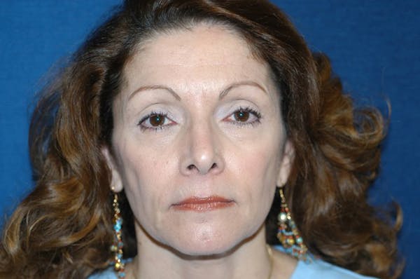 Facelift Before & After Gallery - Patient 6389911 - Image 1
