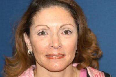 Facelift Before & After Gallery - Patient 6389911 - Image 2