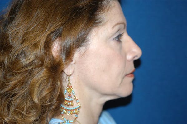 Facelift Before & After Gallery - Patient 6389911 - Image 3