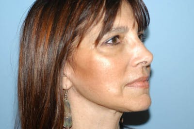Facelift Before & After Gallery - Patient 6389913 - Image 4