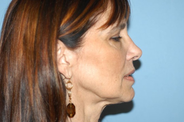 Facelift Before & After Gallery - Patient 6389913 - Image 5