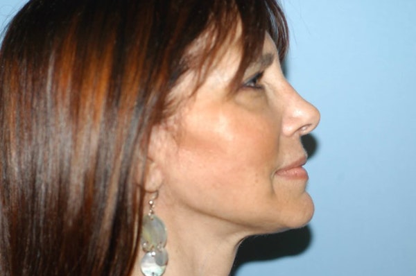 Facelift Before & After Gallery - Patient 6389913 - Image 6