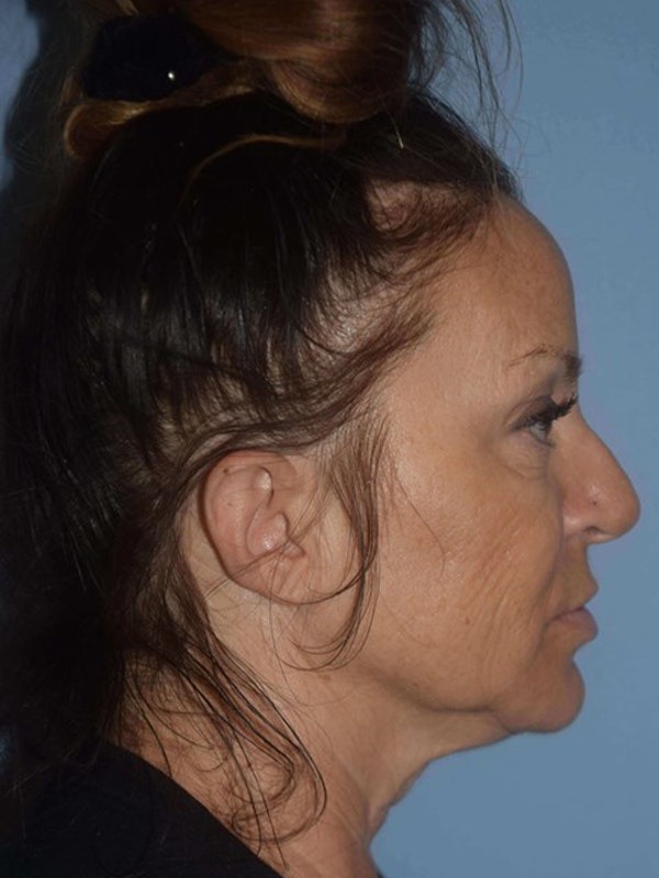 Facelift Before & After Gallery - Patient 9563911 - Image 5