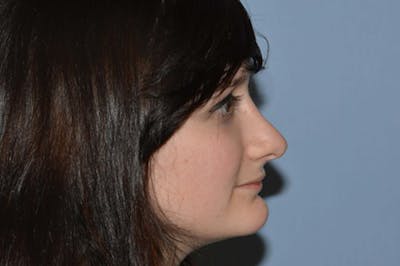 Rhinoplasty Before & After Gallery - Patient 6389941 - Image 4