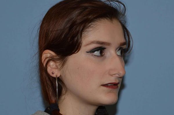 Rhinoplasty Before & After Gallery - Patient 6389941 - Image 5