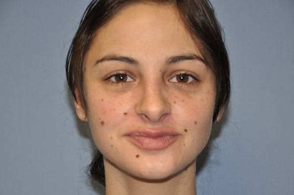 Rhinoplasty Before & After Gallery - Patient 6389942 - Image 2