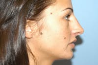 Rhinoplasty Before & After Gallery - Patient 6389942 - Image 1