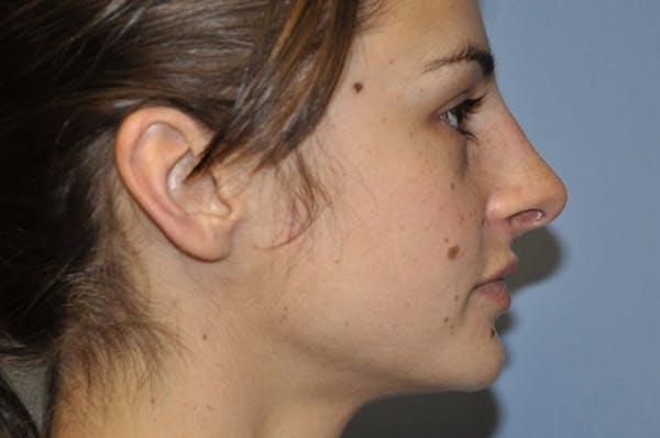 Rhinoplasty Before & After Gallery - Patient 6389942 - Image 4