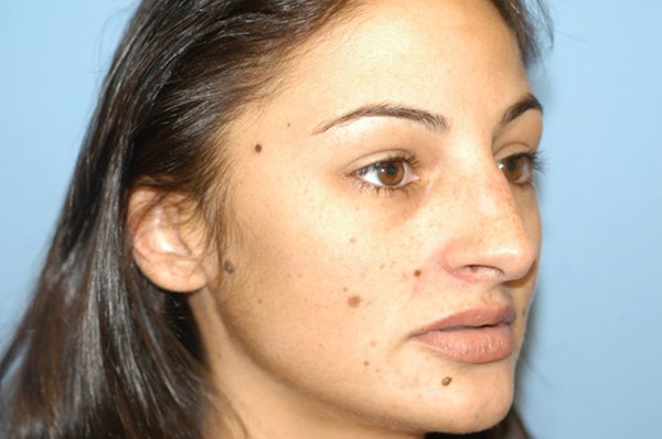 Rhinoplasty Before & After Gallery - Patient 6389942 - Image 5