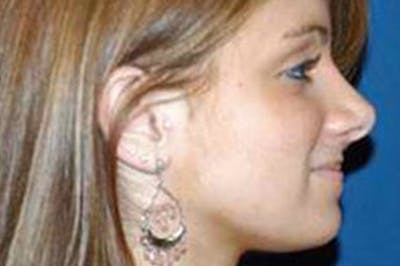 Rhinoplasty Before & After Gallery - Patient 6389944 - Image 2