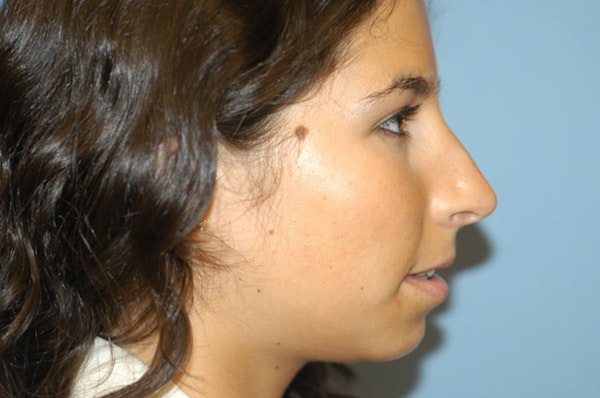 Rhinoplasty Before & After Gallery - Patient 6389947 - Image 1