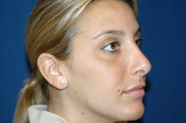 Rhinoplasty Before & After Gallery - Patient 6389950 - Image 6