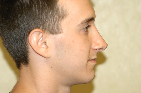 Rhinoplasty Before & After Gallery - Patient 6389952 - Image 2