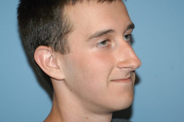 Rhinoplasty Before & After Gallery - Patient 6389952 - Image 5