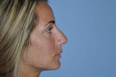 Rhinoplasty Before & After Gallery - Patient 6389954 - Image 1