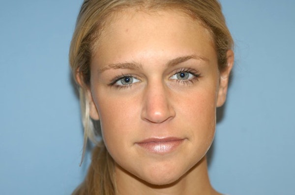Rhinoplasty Before & After Gallery - Patient 6389955 - Image 3