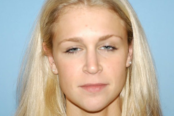Rhinoplasty Before & After Gallery - Patient 6389955 - Image 4