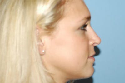 Rhinoplasty Before & After Gallery - Patient 6389955 - Image 2