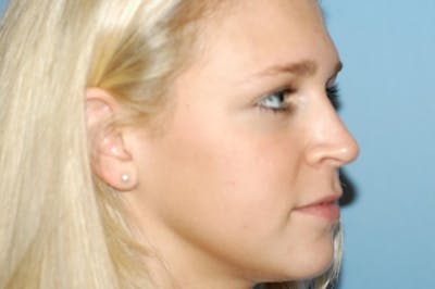 Rhinoplasty Before & After Gallery - Patient 6389955 - Image 6