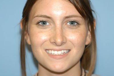 Rhinoplasty Before & After Gallery - Patient 6389956 - Image 4