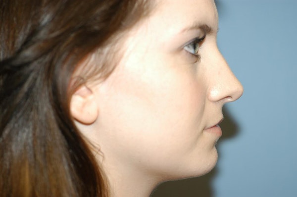 Rhinoplasty Before & After Gallery - Patient 6389956 - Image 1