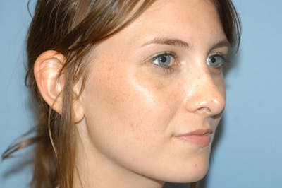 Rhinoplasty Before & After Gallery - Patient 6389956 - Image 6