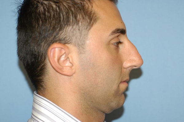 Rhinoplasty Before & After Gallery - Patient 6389958 - Image 1