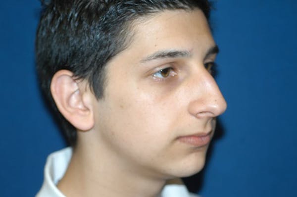 Rhinoplasty Before & After Gallery - Patient 6389959 - Image 5