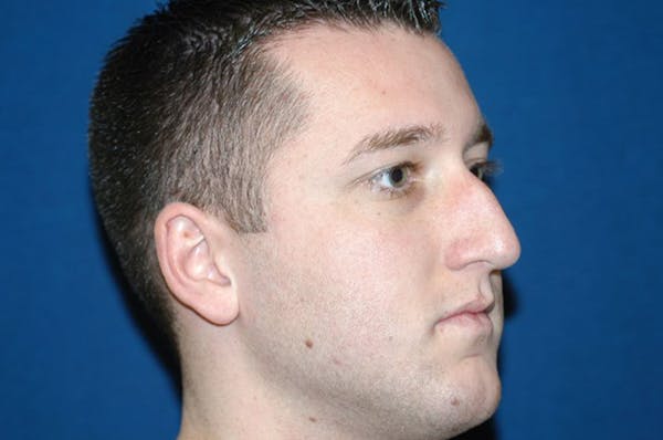Rhinoplasty Before & After Gallery - Patient 6389962 - Image 5