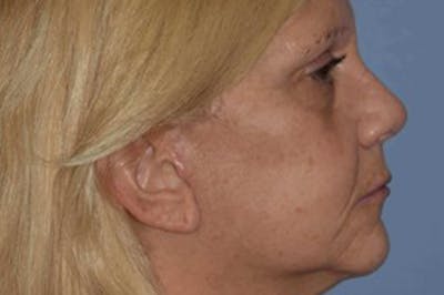 Rhinoplasty Before & After Gallery - Patient 6406141 - Image 2