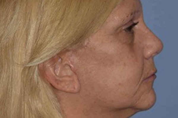 Rhinoplasty Before & After Gallery - Patient 6406141 - Image 2