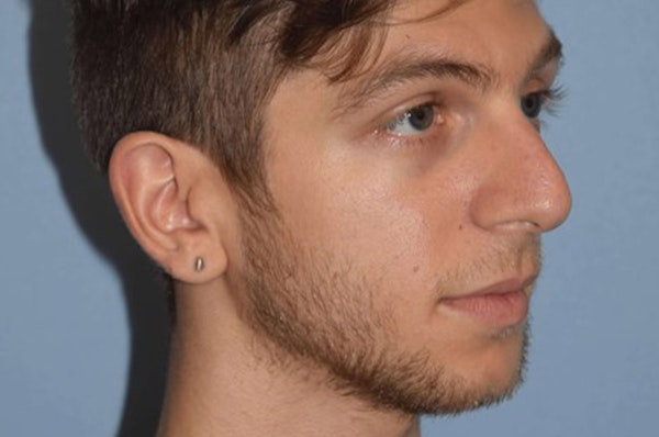 Rhinoplasty Before & After Gallery - Patient 6406144 - Image 5
