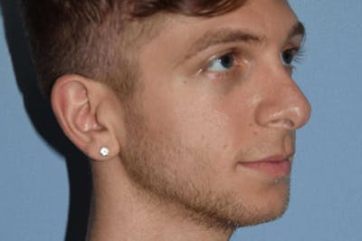 Rhinoplasty Before & After Gallery - Patient 6406144 - Image 6