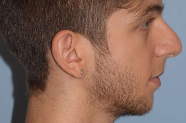 Rhinoplasty Before & After Gallery - Patient 6406144 - Image 1