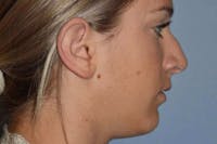 Rhinoplasty Before & After Gallery - Patient 6406145 - Image 1