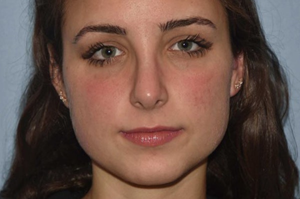 Rhinoplasty Before & After Gallery - Patient 6406147 - Image 4