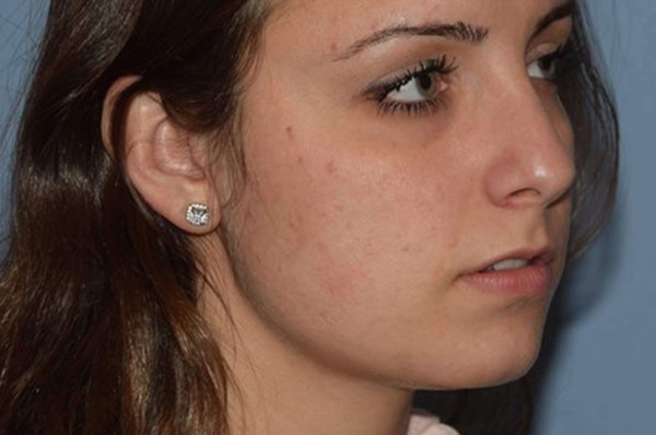 Rhinoplasty Before & After Gallery - Patient 6406147 - Image 5