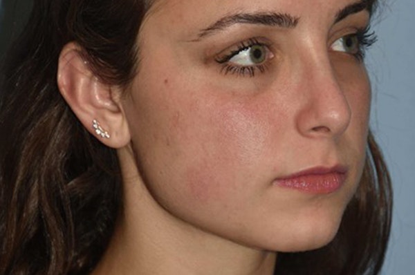 Rhinoplasty Before & After Gallery - Patient 6406147 - Image 6