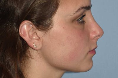 Rhinoplasty Before & After Gallery - Patient 6406147 - Image 2