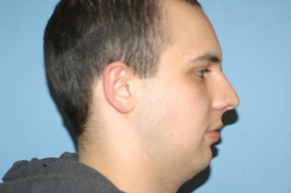 Chin Augmentation Before & After Gallery - Patient 6389456 - Image 1