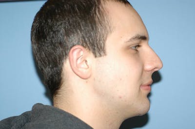 Chin Augmentation Before & After Gallery - Patient 6389456 - Image 2