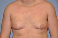 Gynecomastia Before & After Gallery - Patient 6389429 - Image 1