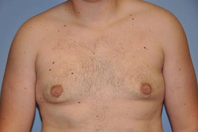 Gynecomastia Before & After Gallery - Patient 6389429 - Image 2