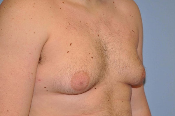 Gynecomastia Before & After Gallery - Patient 6389429 - Image 3