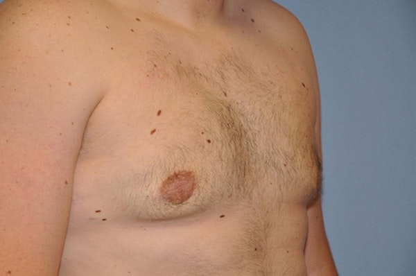 Gynecomastia Before & After Gallery - Patient 6389429 - Image 4