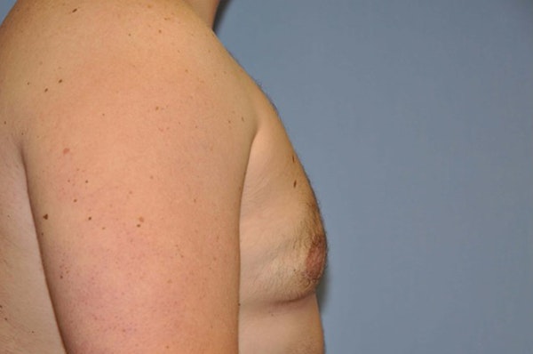 Gynecomastia Before & After Gallery - Patient 6389429 - Image 6