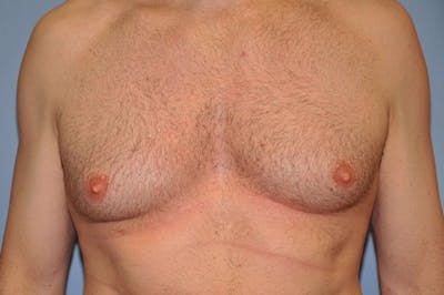Gynecomastia Before & After Gallery - Patient 6389431 - Image 1